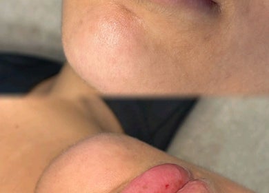 Chin skin care transformation at Aesthetics By Kiki, Leeds, England, GB, showcasing smooth, radiant texture.