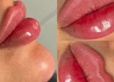 Close-up of perfectly enhanced lips at Aesthetixsbysarah Silkcorps Ltd, Wembley, England, GB.