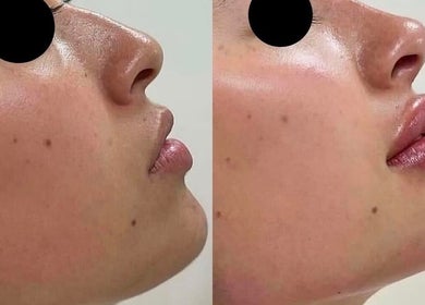 Before and after skin rejuvenation at Aesthetixsbysarah Silkcorps Ltd, Wembley, England, GB.