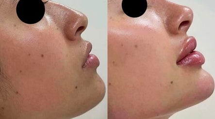 Before and after skin rejuvenation at Aesthetixsbysarah Silkcorps Ltd, Wembley, England, GB.