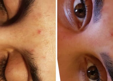 Close-up of a face showing improved skin texture at The Wax Club, Glasgow, Scotland, GB.