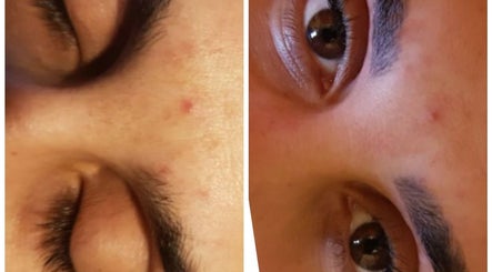 Close-up of a face showing improved skin texture at The Wax Club, Glasgow, Scotland, GB.