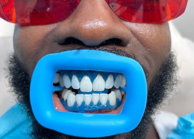 Teeth whitening process at The RL Aesthetic, Milton Keynes, England, GB with blue dental guard and red protective glasses.