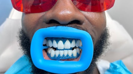 Teeth whitening process at The RL Aesthetic, Milton Keynes, England, GB with blue dental guard and red protective glasses.