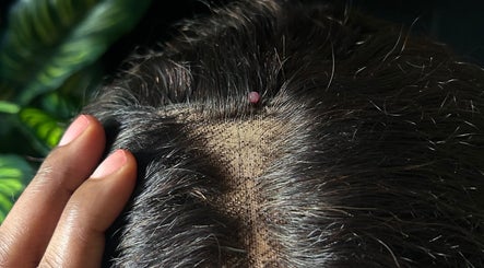 Close-up of a scalp with a small bump, highlighting hair care at WIGNOVATE, Ocho Rios, JM.