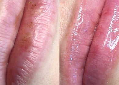 Antes y después de tratamiento de labios en Kairós Clinic, Concepción, Bío Bío, CL.