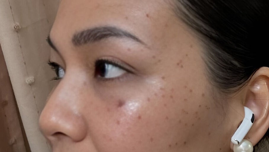 Close-up of radiant skin after treatment at Glazed Beauty Lounge, Antipolo City, Calabarzon, PH.