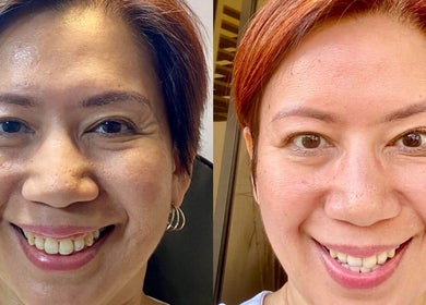 Before and after skincare results at Glazed Beauty Lounge, Antipolo City, Calabarzon, PH.
