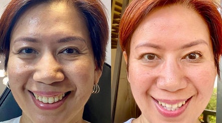 Before and after skincare results at Glazed Beauty Lounge, Antipolo City, Calabarzon, PH.