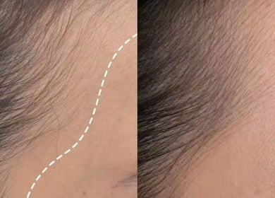 Before and after hairline enhancement at Gentle Cactus, Raffles Place, SG.