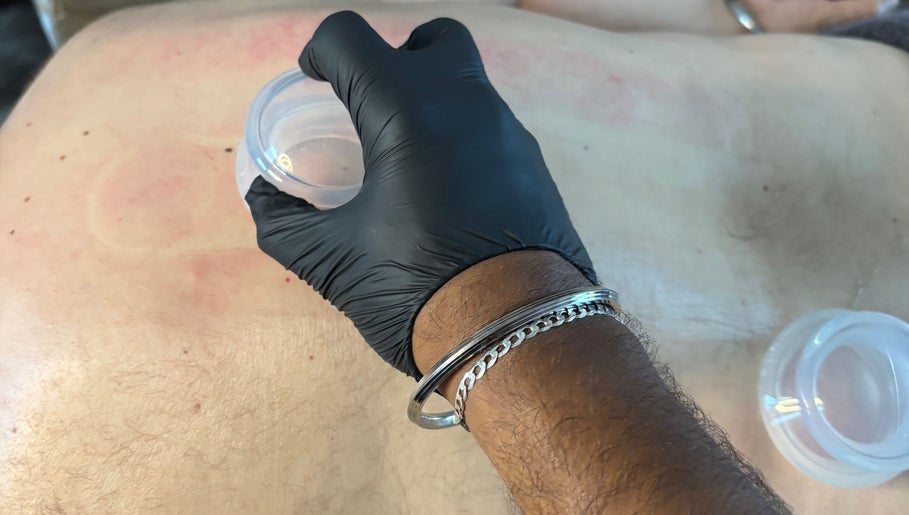 Cupping therapy at JSB Practices, Ilford, England, GB enhances wellness and relaxation.
