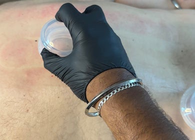 Cupping therapy at JSB Practices, Ilford, England, GB enhances wellness and relaxation.