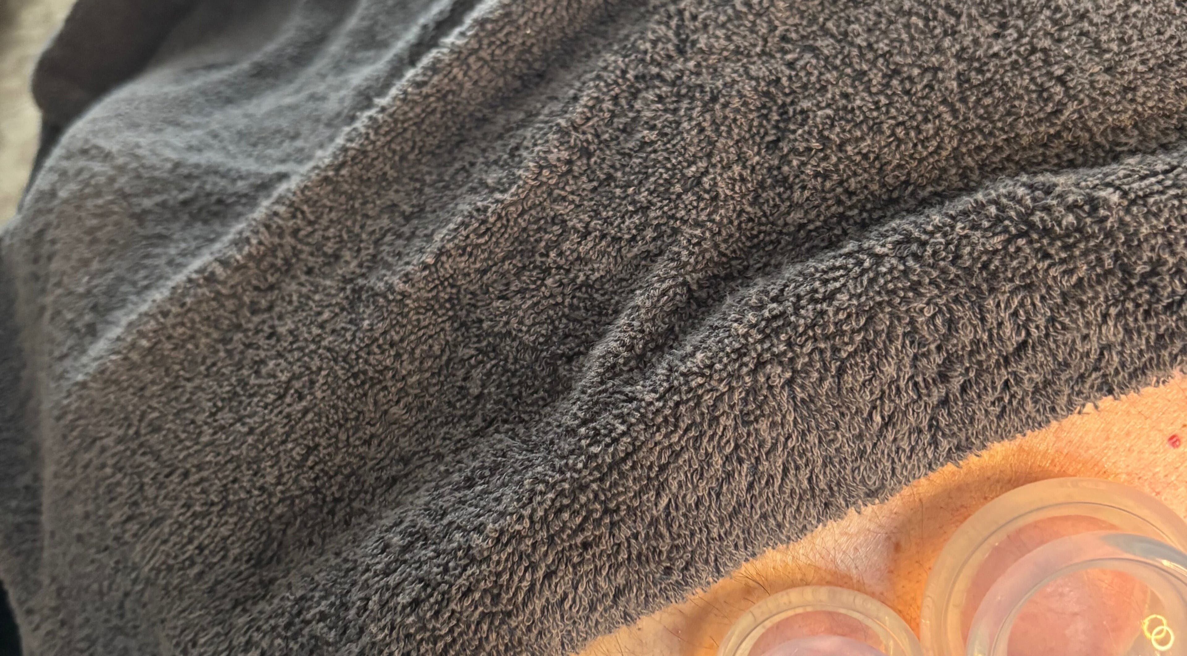 Relaxing cupping therapy at JSB Practices, Ilford, England, GB with soft towel cover.