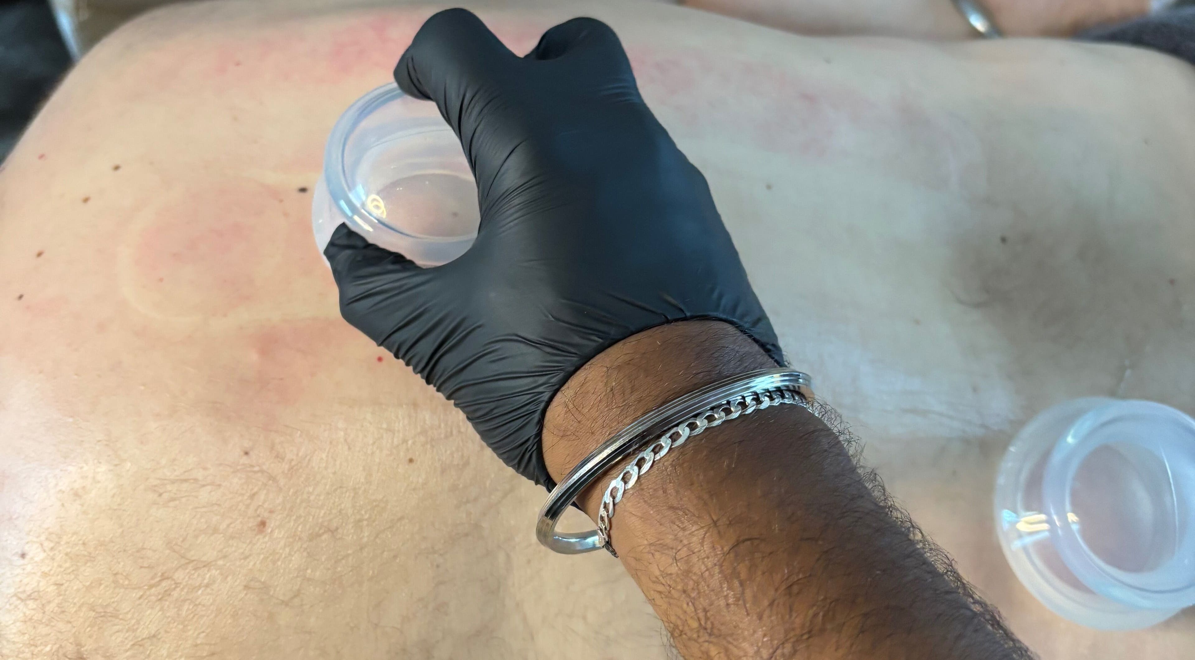 Cupping therapy at JSB Practices, Ilford, England, GB, promoting wellness and relaxation.