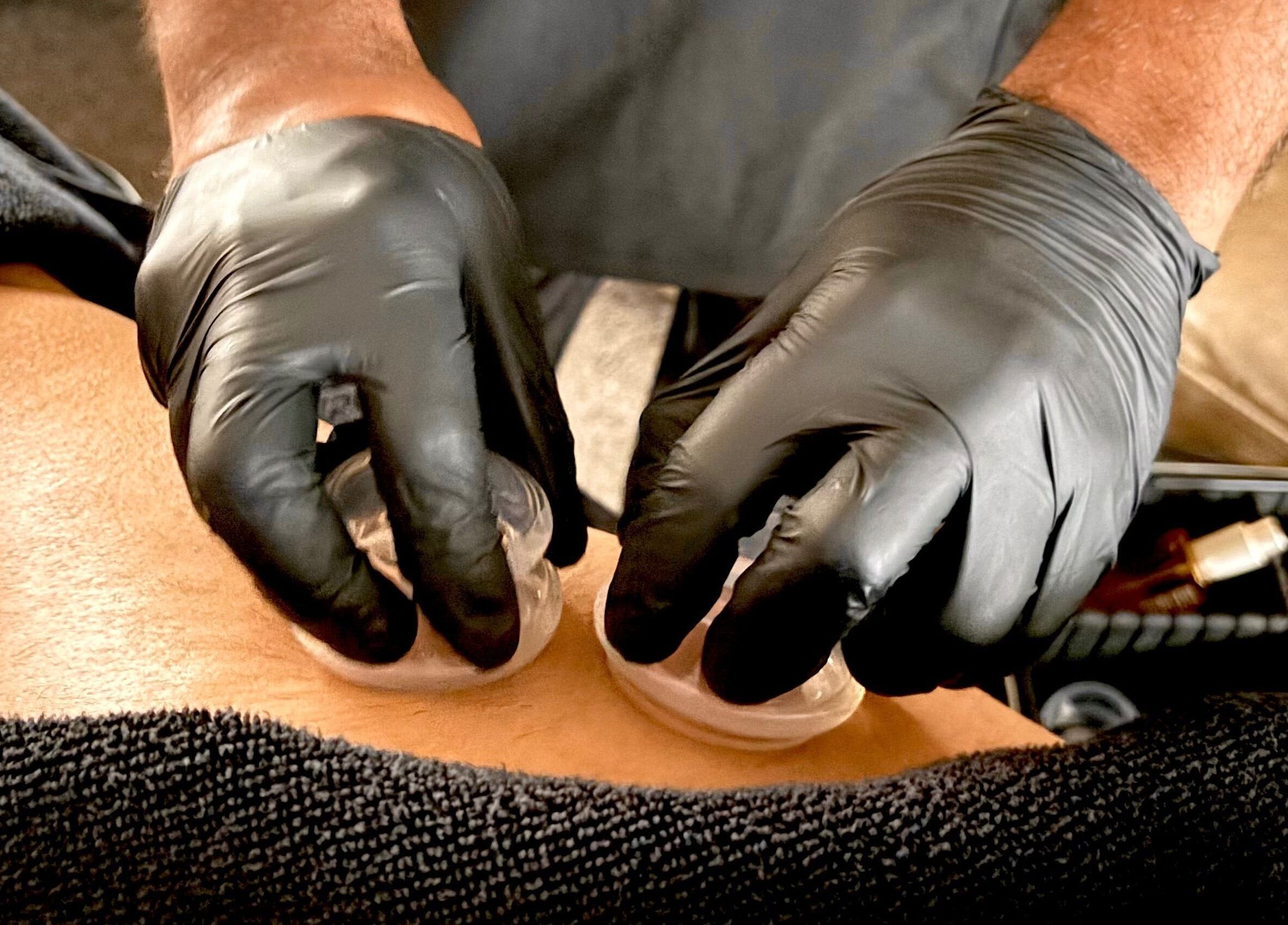 Cupping therapy session at JSB Practices, Ilford, England, GB, showcasing holistic wellness.