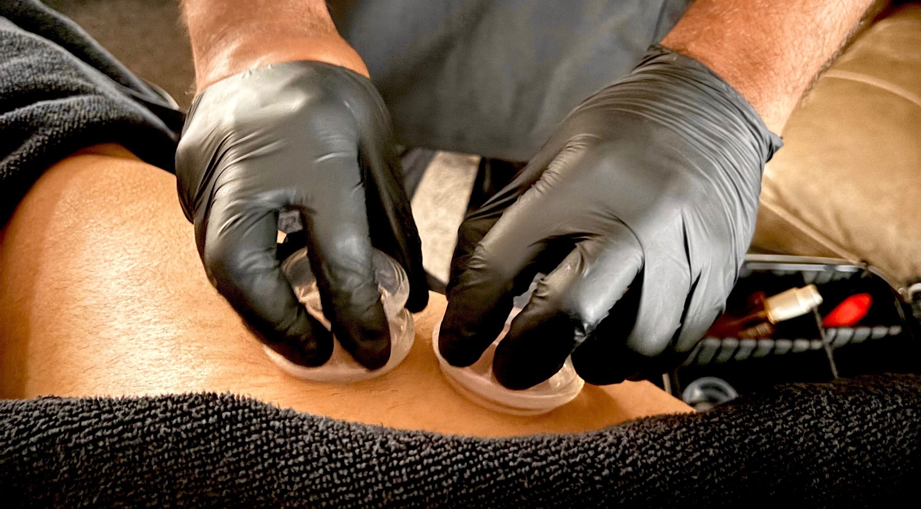 Cupping therapy session at JSB Practices, Ilford, England, GB, showcasing holistic wellness.