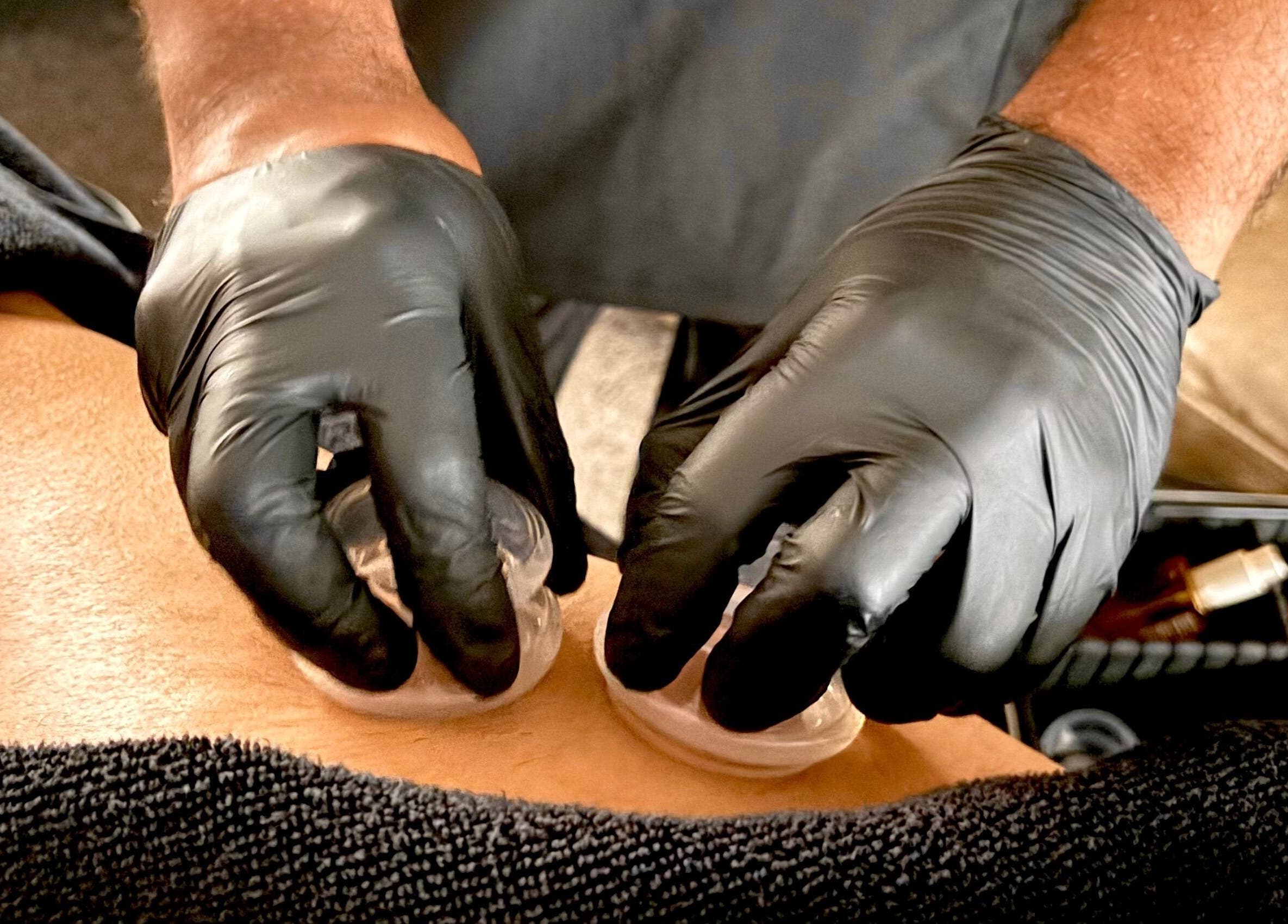 Cupping therapy session at JSB Practices in Ilford, England, GB, enhancing wellness and relaxation.