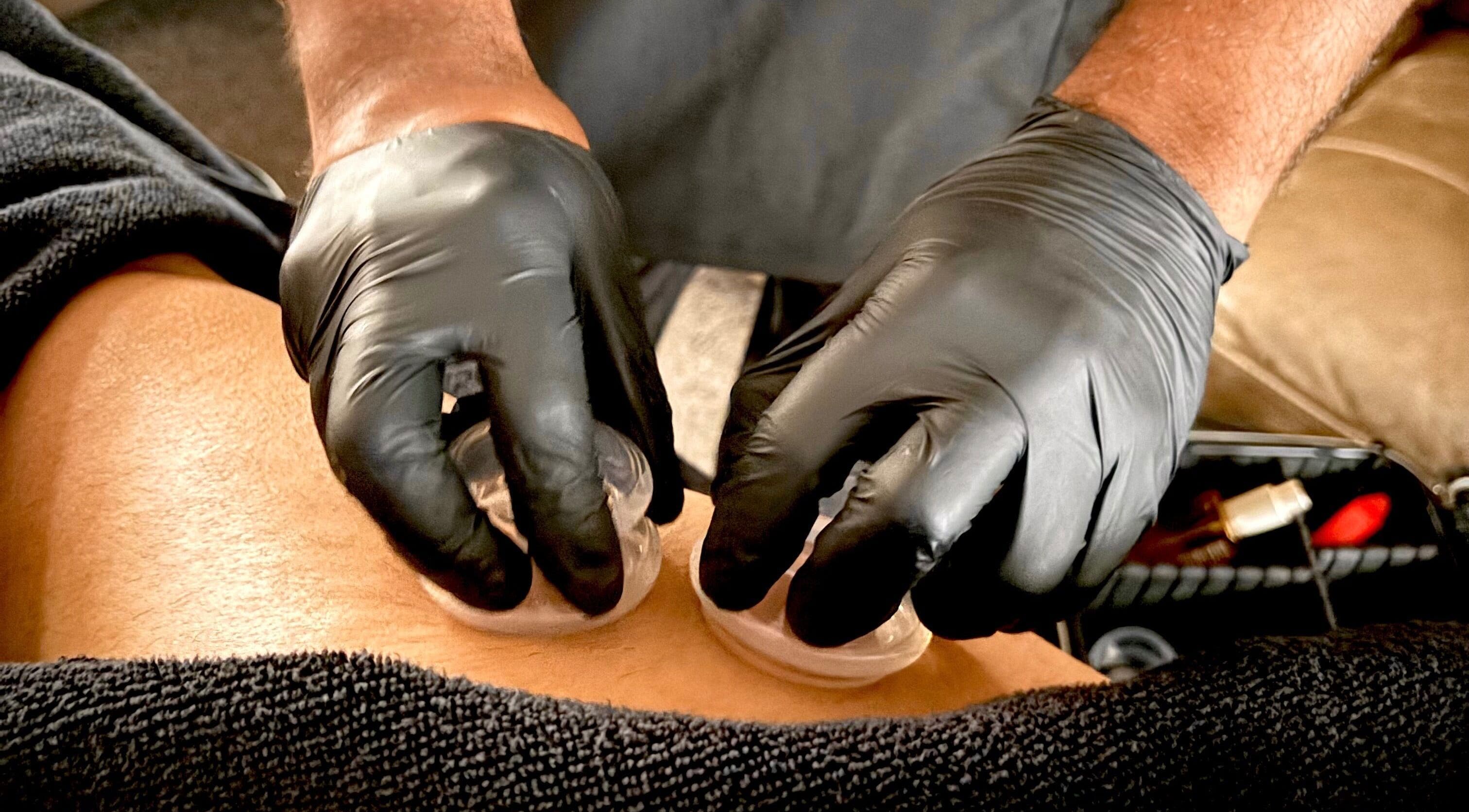 Cupping therapy session at JSB Practices in Ilford, England, GB, enhancing wellness and relaxation.