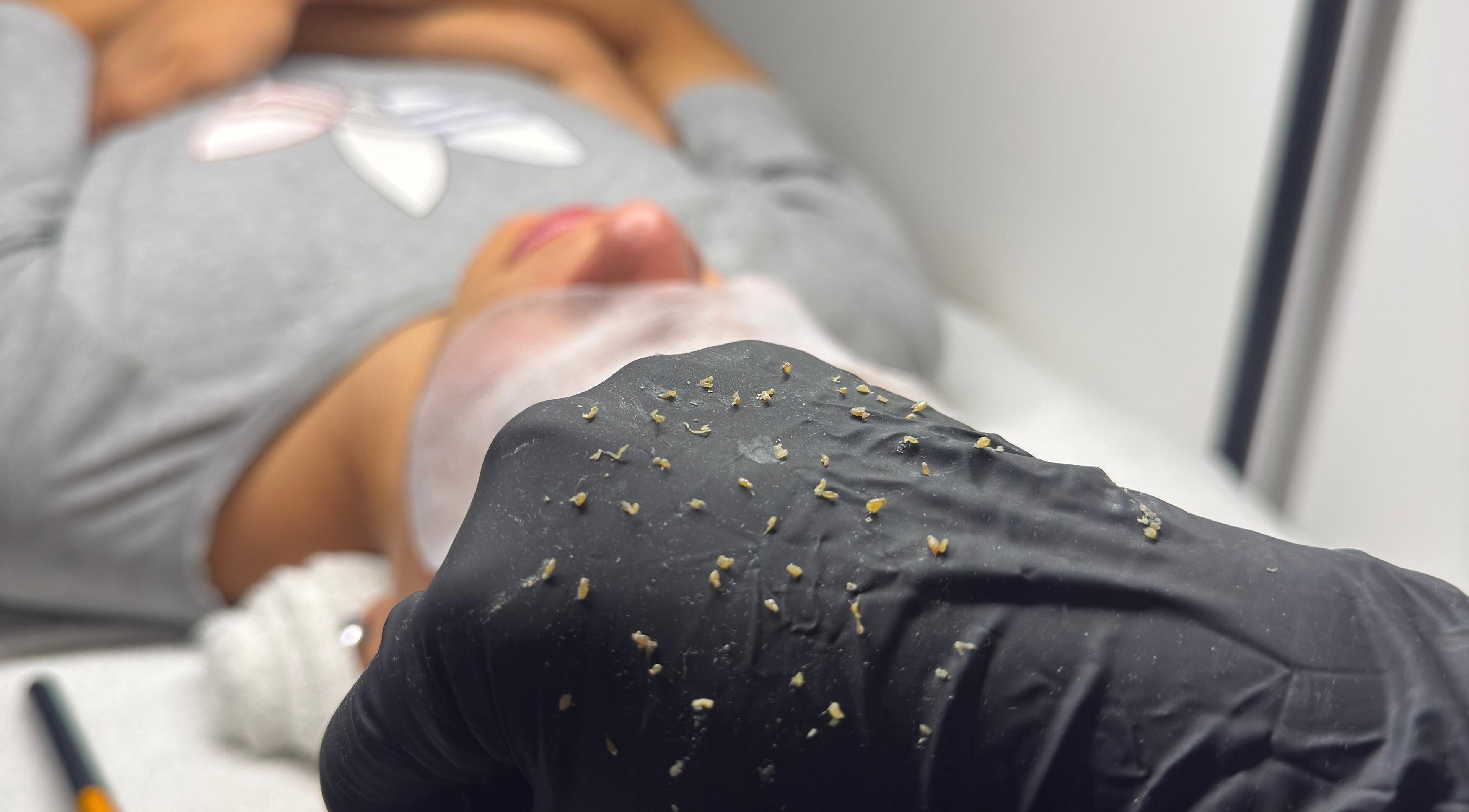 Tratamiento facial de exfoliación en Atypical Skin Studio, Madrid, Comunidad De Madrid, ES.