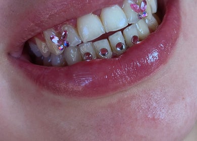 Dekoracje na zębach z kryształkami w Diamond Smile Kalisz, Kalisz, Województwo Wielkopolskie, PL.