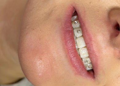 Błyszcząca biżuteria na zębach w Diamond Smile Kalisz, Kalisz, Województwo Wielkopolskie, PL.