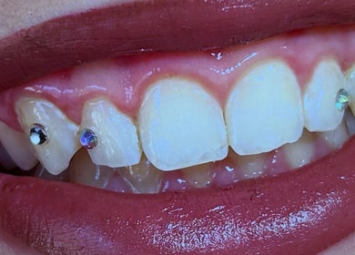 Ozdobione diamentami zęby w Diamond Smile Kalisz, Kalisz, Województwo Wielkopolskie, PL.