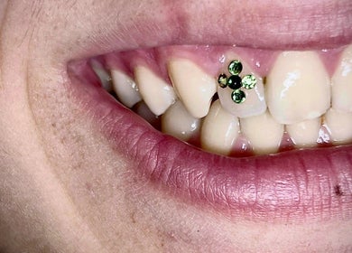 Diamond Smile Kalisz w Kaliszu, Województwo Wielkopolskie, PL ukazuje ząb z zielonym zdobieniem dentystycznym.