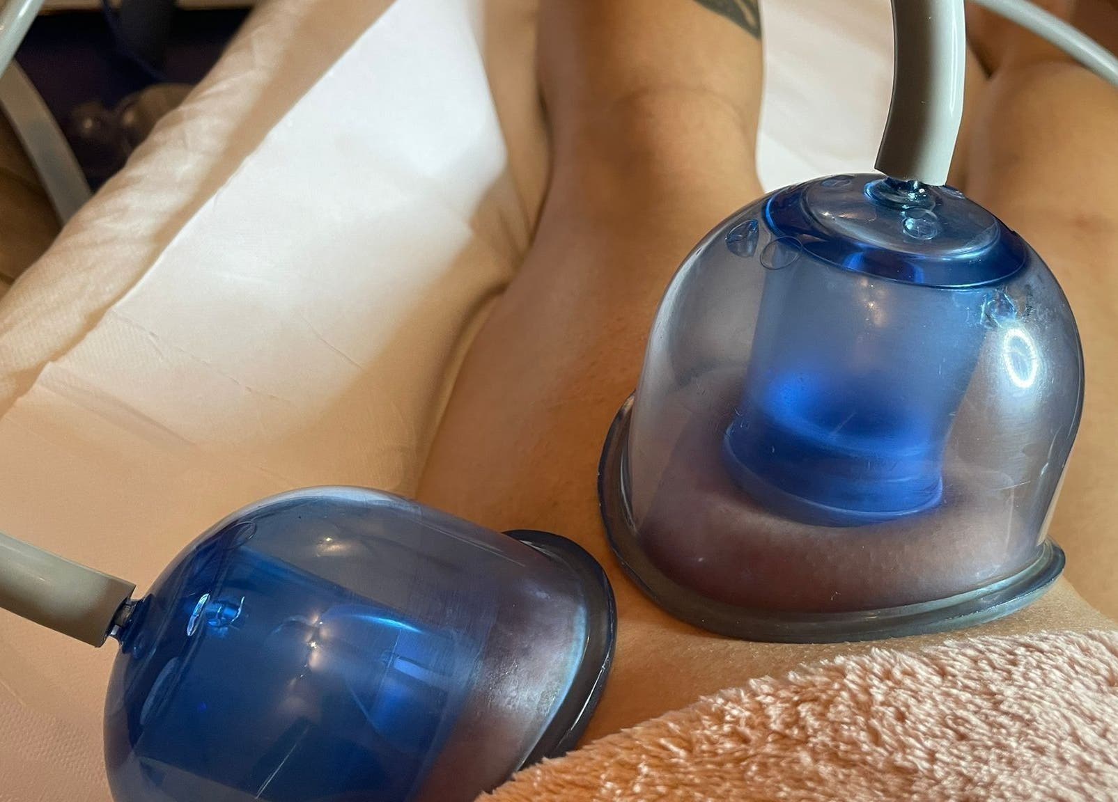 Cupping therapy in corso a Flor de Lis - Estetica Brasiliana, Milano, Lombardia, IT.