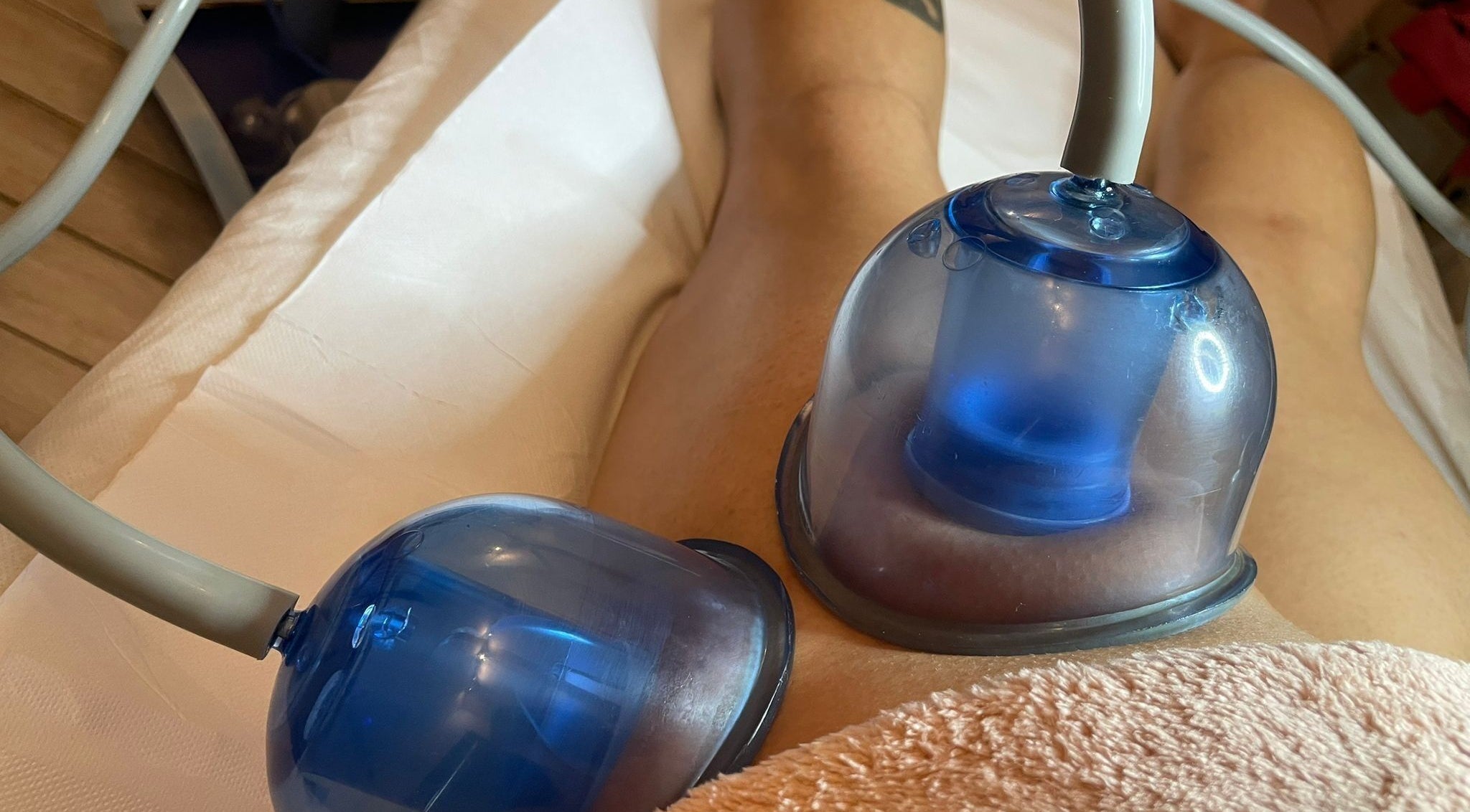 Trattamento cupping a Flor de Lis - Estetica, Milano, Lombardia, IT su coscia di cliente rilassata.