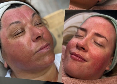 Rejuvenated faces after skincare treatment at Pure SKNN, Warrington, England, GB.