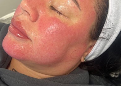 Facial treatment at Beauty By Nichola in Bromborough, England, GB, highlighting rejuvenated skin.