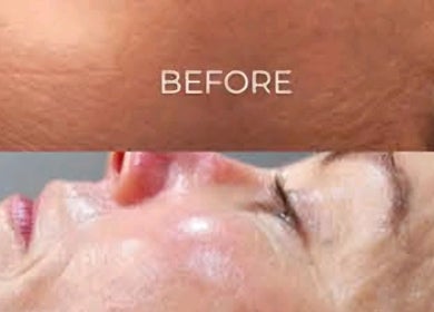 Before and after skin treatment at Glo₂Facial by GeneoX SA - Woolworths Canal Walk, Cape Town, Western Cape, ZA.