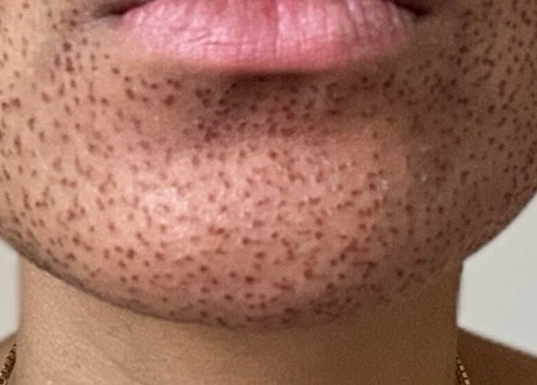 Närbild av haka efter behandling på Jac Ferrer wellness i Stockholm, Stockholms Län, SE.