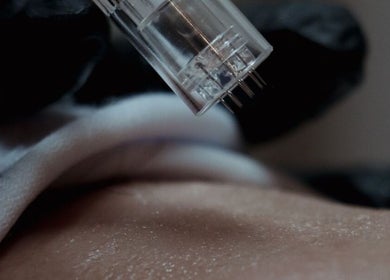 Microneedling treatment at RUH Skin, Riyadh, Riyadh Province, SA, enhancing skin texture and glow.