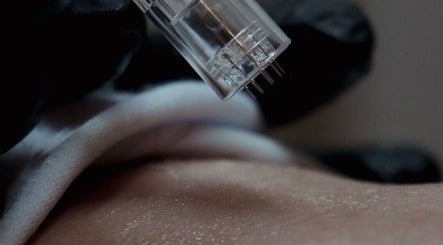 Microneedling treatment at RUH Skin, Riyadh, Riyadh Province, SA, enhancing skin texture and glow.