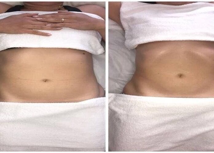 Antes e depois de tratamento corporal na Pietra Fernanda - Estética & Bem-estar, São Paulo, São Paulo, BR.