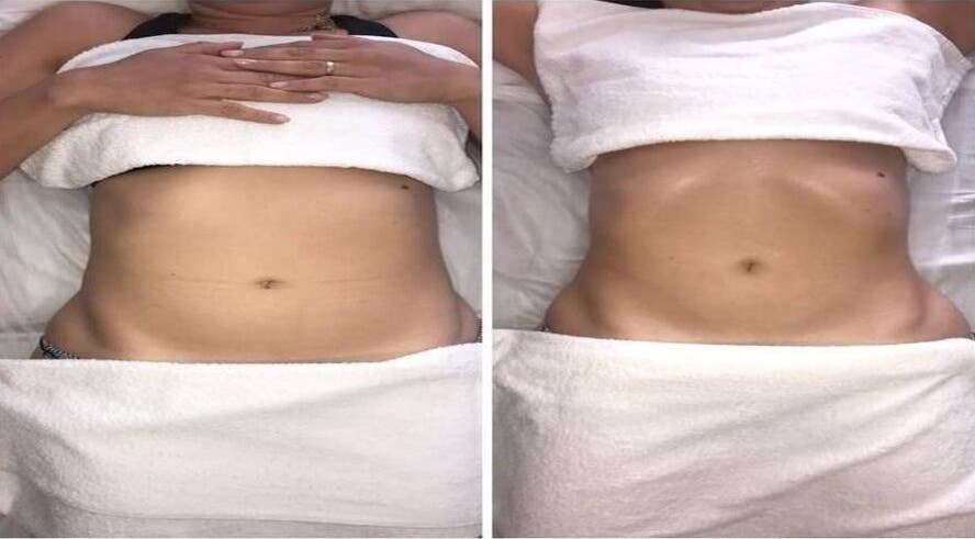 Antes e depois de tratamento corporal na Pietra Fernanda - Estética & Bem-estar, São Paulo, São Paulo, BR.
