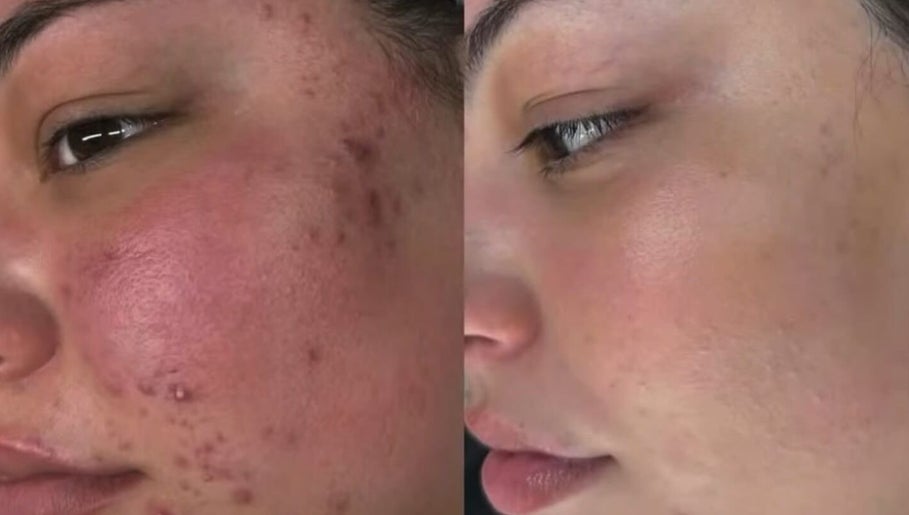 Before and after acne treatment at Medglow Skincare & Wellbeing, Dublin, County Dublin, IE.