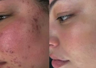 Before and after acne treatment at Medglow Skincare & Wellbeing, Dublin, County Dublin, IE.