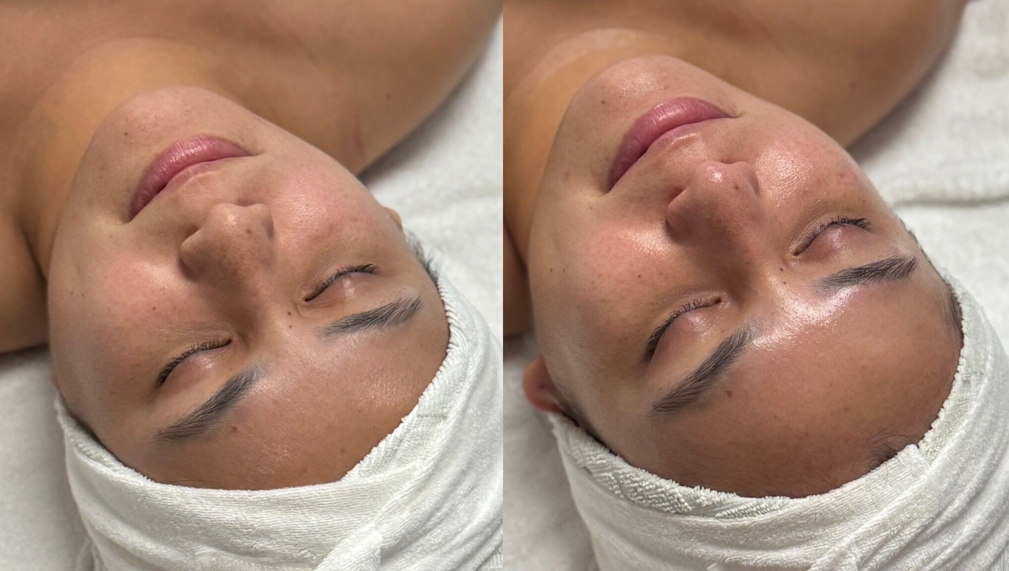 Before and after facial at The Aesthetic Refinery in Orange County, California, US showcasing skin radiance.