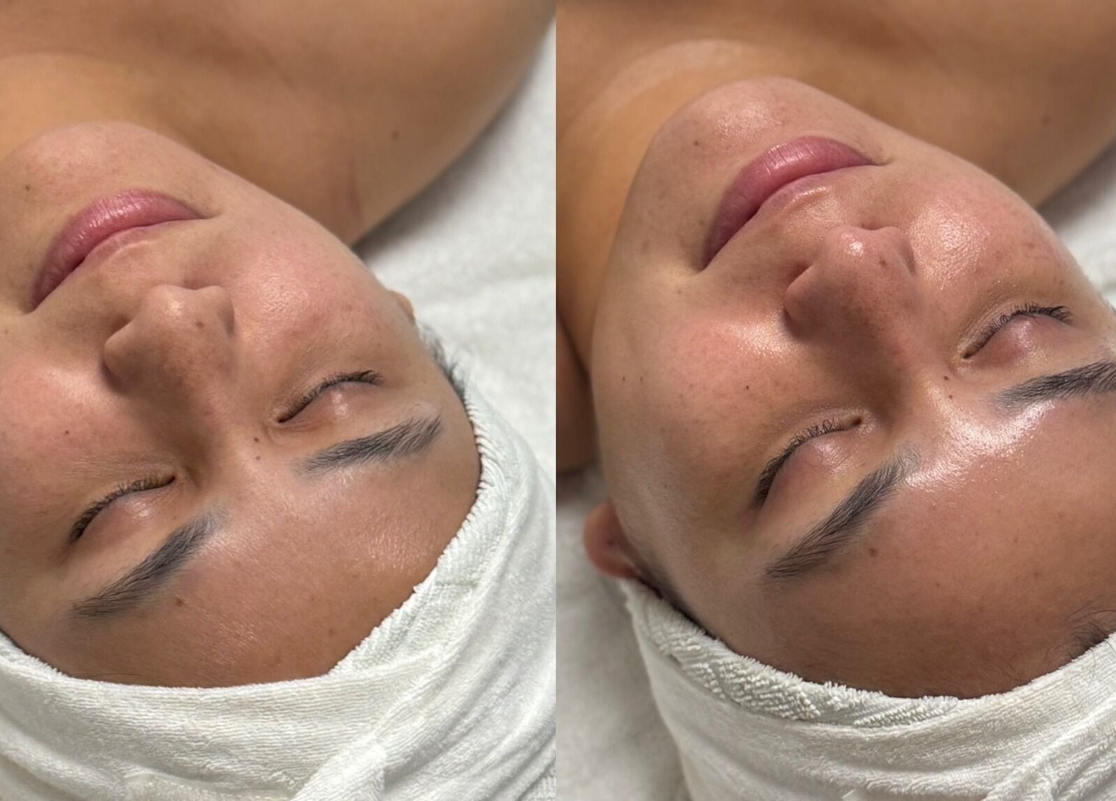 Before and after facial at The Aesthetic Refinery in Orange County, California, US showcasing skin radiance.