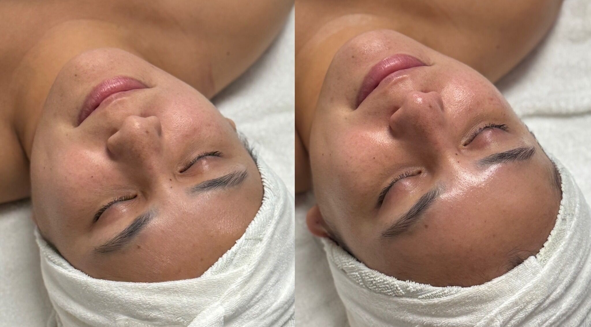 Before and after facial at The Aesthetic Refinery in Orange County, California, US showcasing skin radiance.