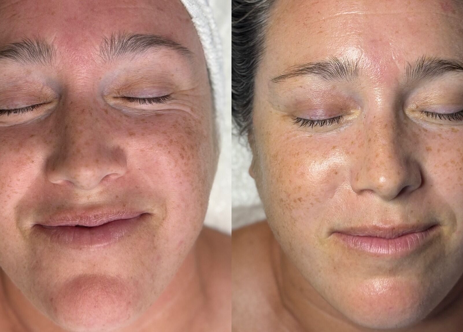 Facial before and after at The Aesthetic Refinery in Orange County, California, US showcasing glowing skin.
