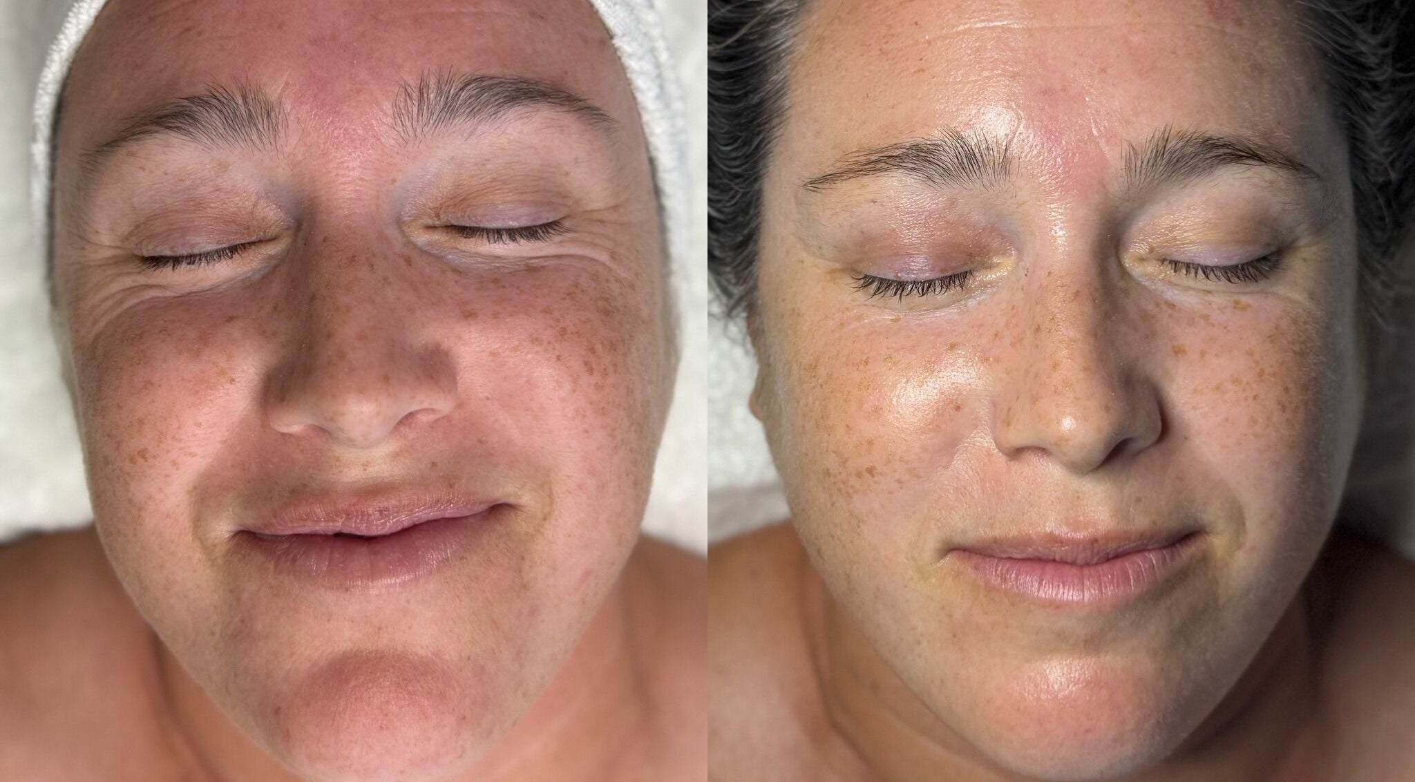 Facial before and after at The Aesthetic Refinery in Orange County, California, US showcasing glowing skin.