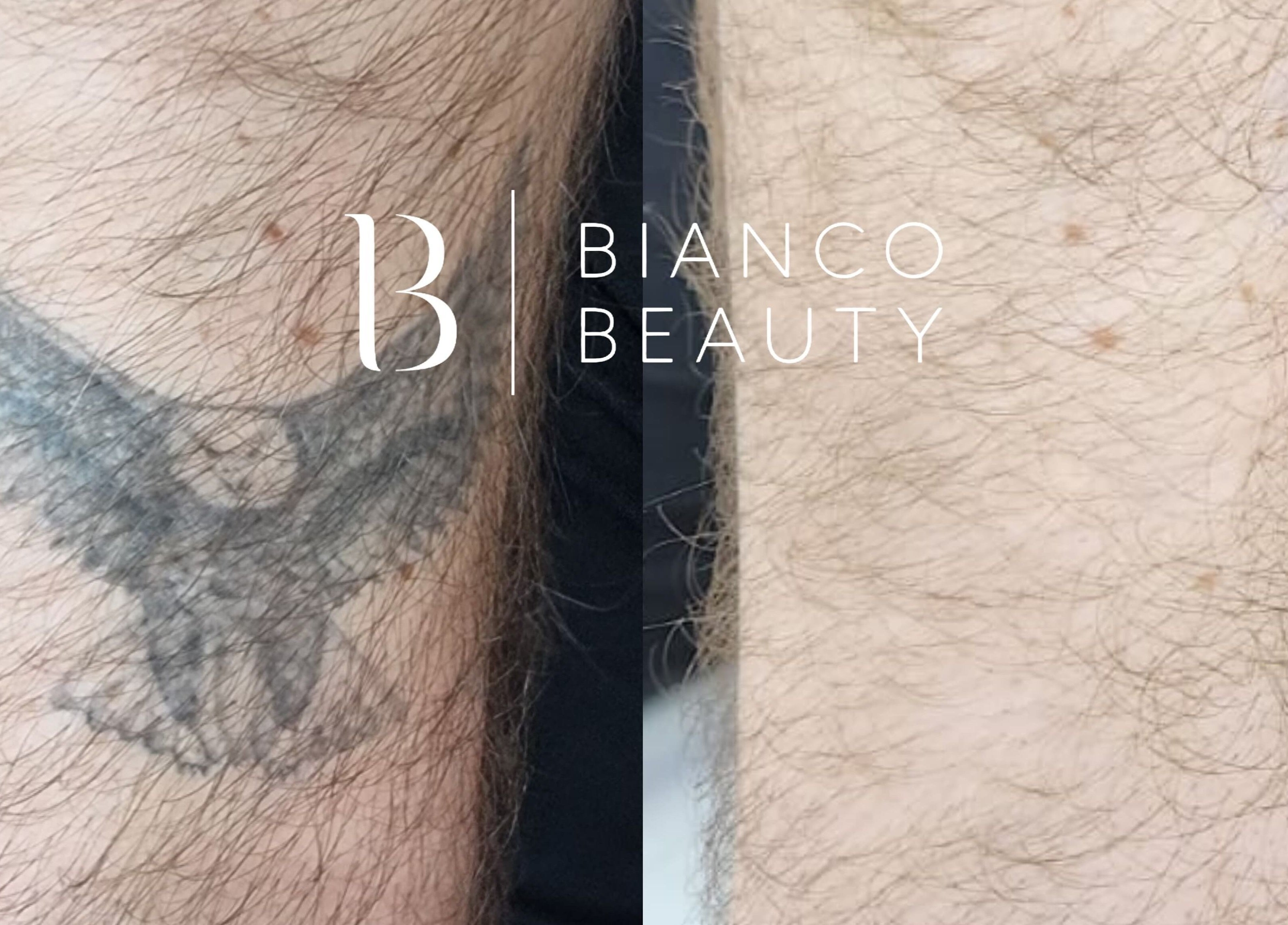 Laserowe usuwanie tatuażu w Bianco Beauty Sopot, Sopot, Województwo Pomorskie, PL, z efektem przed i po.
