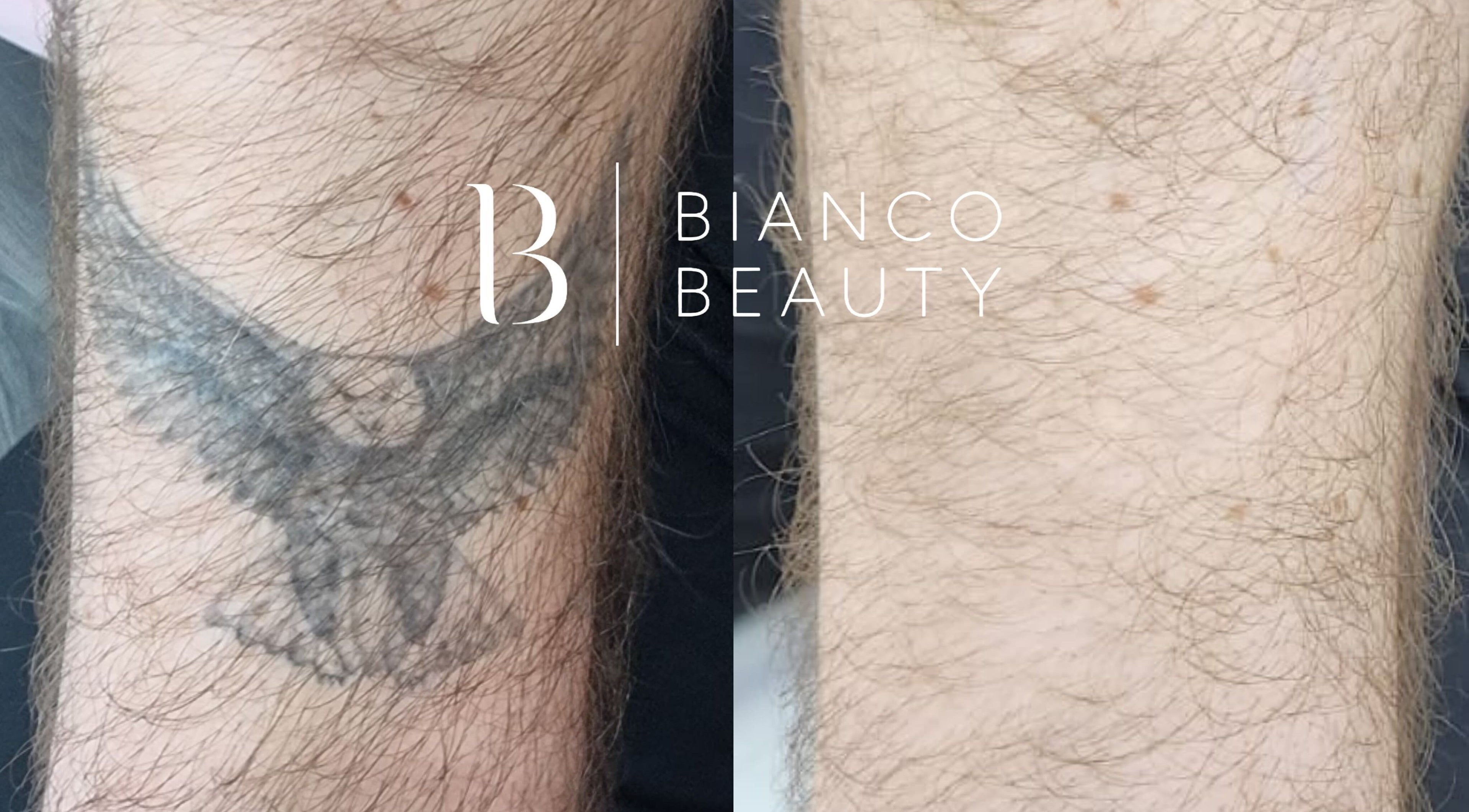 Laserowe usuwanie tatuażu w Bianco Beauty Sopot, Sopot, Województwo Pomorskie, PL, z efektem przed i po.