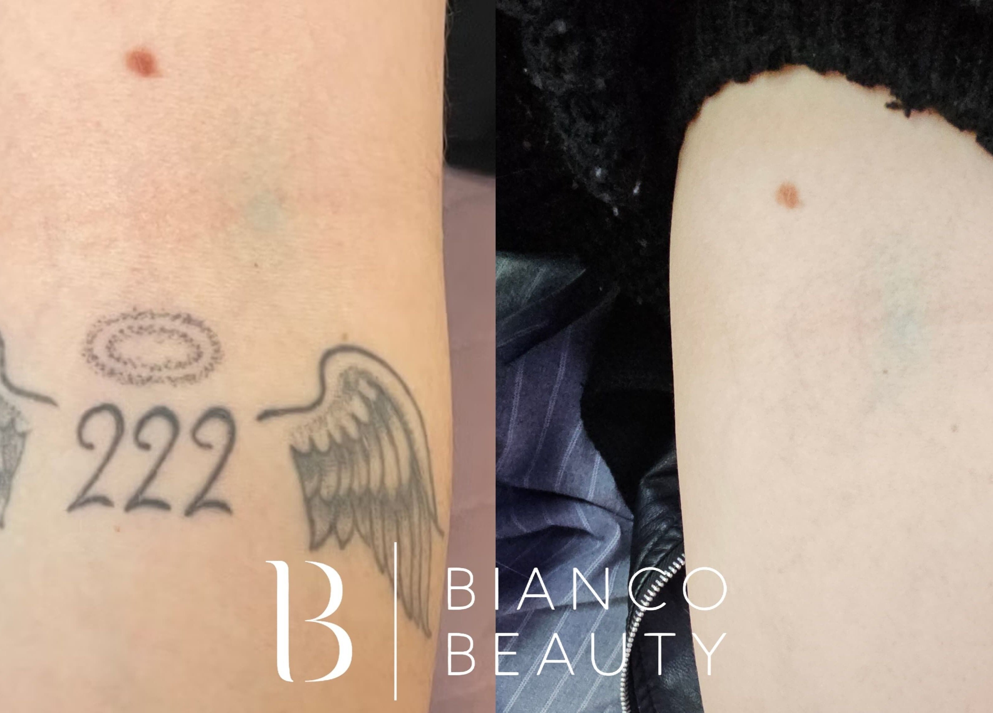 Przed i po usunięciu tatuażu w Bianco Beauty Sopot, Sopot, Województwo Pomorskie, PL.