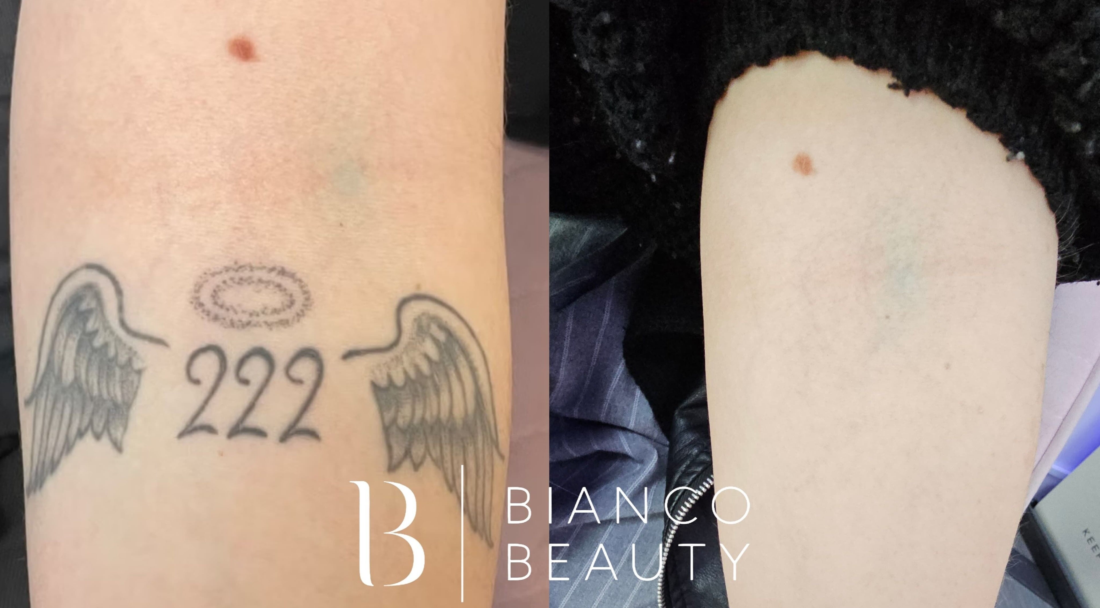 Przed i po usunięciu tatuażu w Bianco Beauty Sopot, Sopot, Województwo Pomorskie, PL.