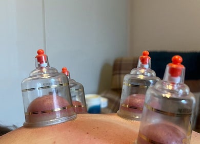 Cupping therapy session at LP Sports Therapy in Burbage, England, GB enhances relaxation and wellness.