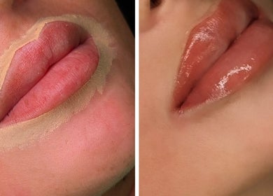 Before and after lip enhancement at LuxeLine Aesthetics, Woodford Green, England, GB.